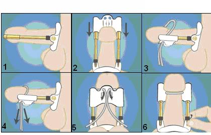 Máy tập dương vật Proextender II
